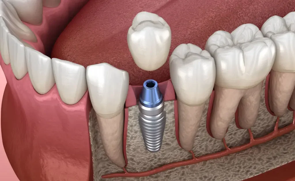 Implantes Dentales: Recupera tu Sonrisa y Confianza